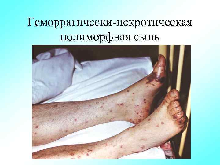 Геморрагически некротическая полиморфная сыпь 
