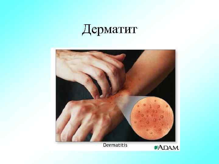 Дерматит 