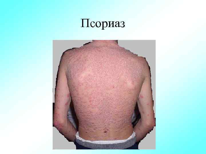 Псориаз 