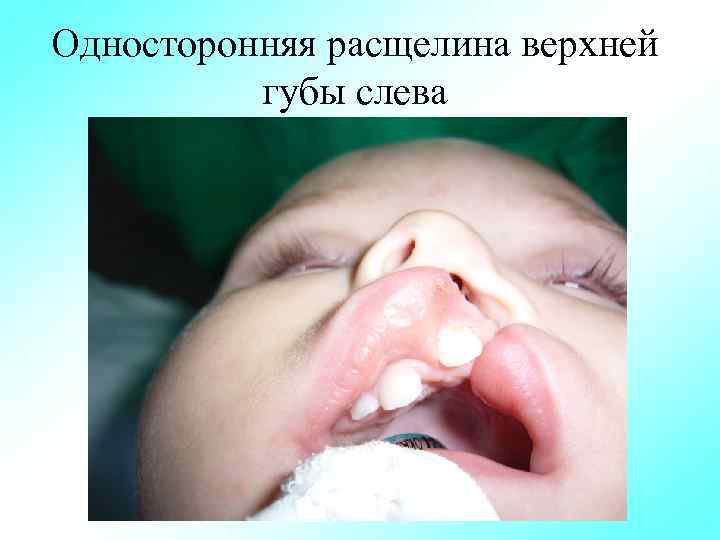 Односторонняя расщелина верхней губы слева 