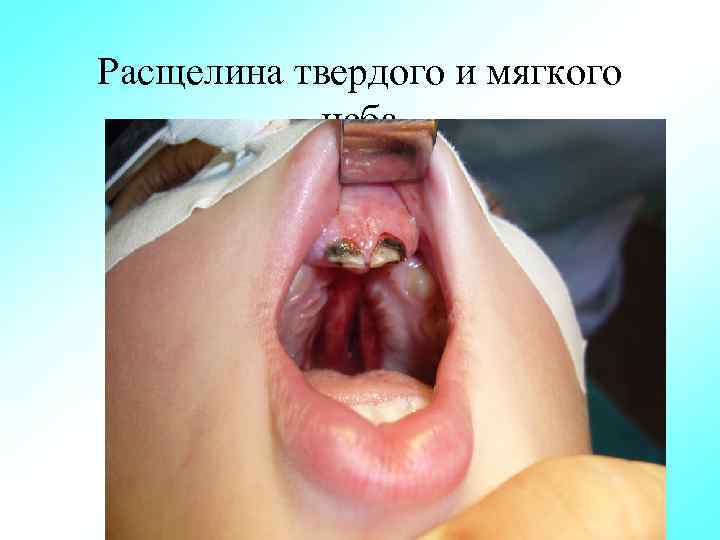 Расщелина твердого и мягкого неба 