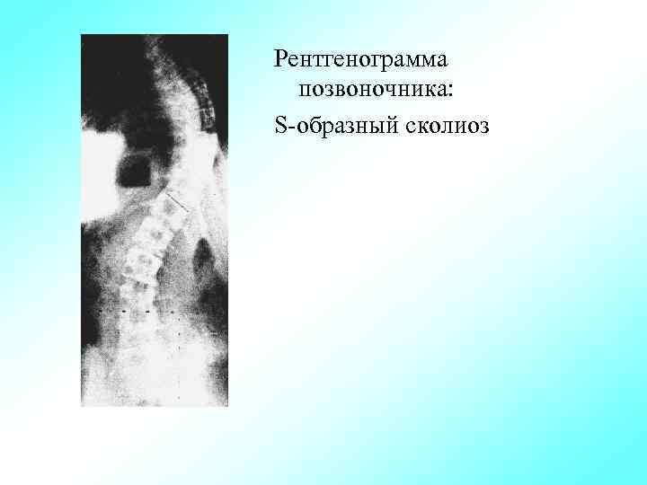 Рентгенограмма позвоночника: S образный сколиоз 