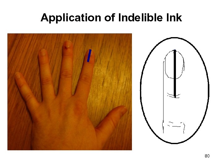 Application of Indelible Ink 80 