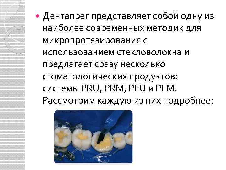 Дентапрег представляет собой одну из наиболее современных методик для микропротезирования с использованием стекловолокна