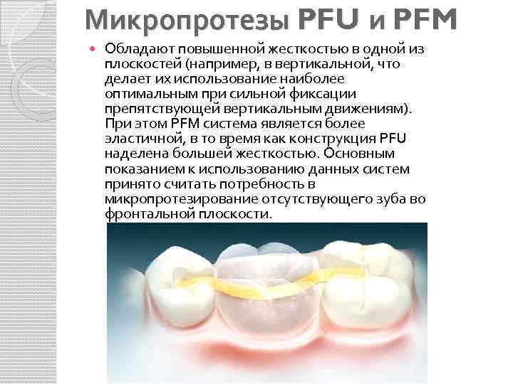 Микропротезы PFU и PFM Обладают повышенной жесткостью в одной из плоскостей (например, в вертикальной,
