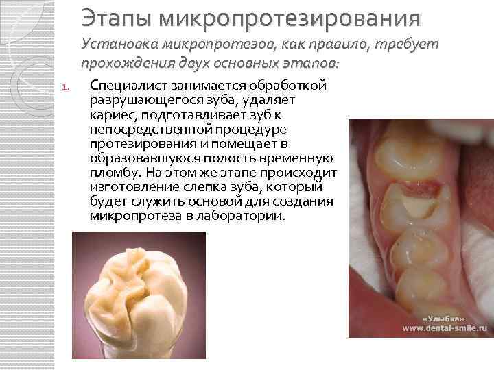 Этапы микропротезирования Установка микропротезов, как правило, требует прохождения двух основных этапов: 1. Специалист занимается