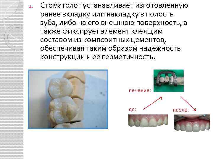 2. Стоматолог устанавливает изготовленную ранее вкладку или накладку в полость зуба, либо на его