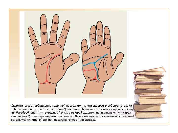 Схематическое изображение ладонной поверхности кисти здорового ребенка (слева) и ребенка того же возраста с