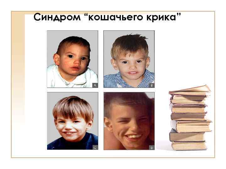 Синдром “кошачьего крика” 