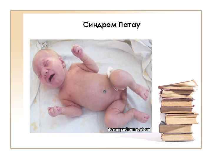 Синдром Патау 