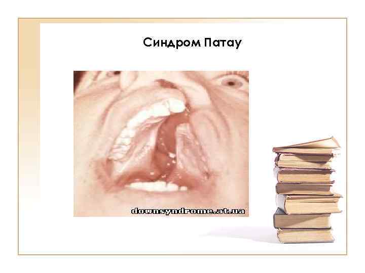 Синдром Патау 