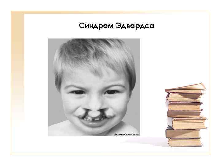 Синдром Эдвардса 