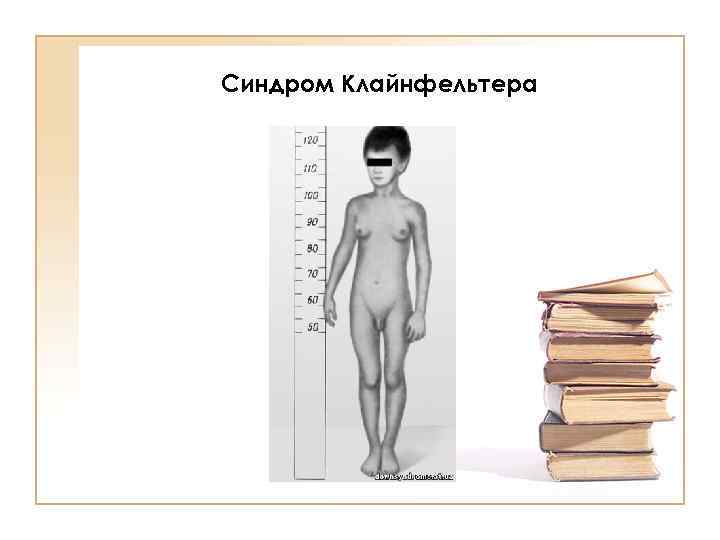 Синдром Клайнфельтера 