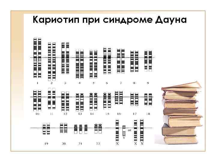 Кариотип при синдроме Дауна 