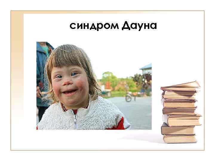 синдром Дауна 