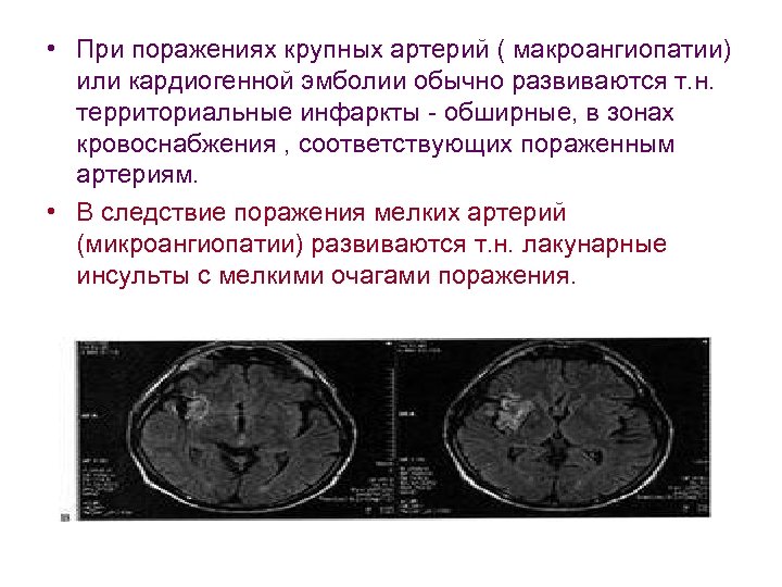 • При поражениях крупных артерий ( макроангиопатии) или кардиогенной эмболии обычно развиваются т.