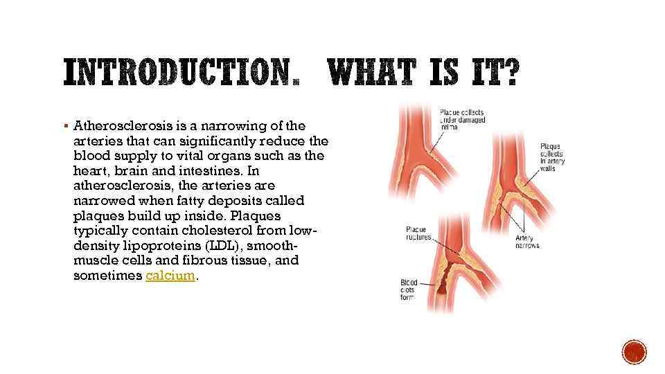 § Atherosclerosis is a narrowing of the arteries that can significantly reduce the blood