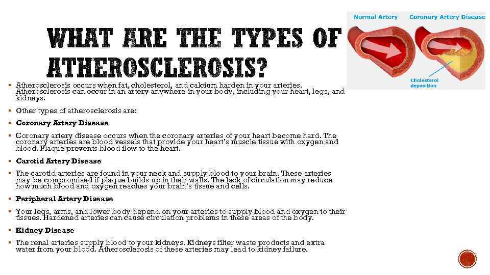 § Atherosclerosis occurs when fat, cholesterol, and calcium harden in your arteries. Atherosclerosis can