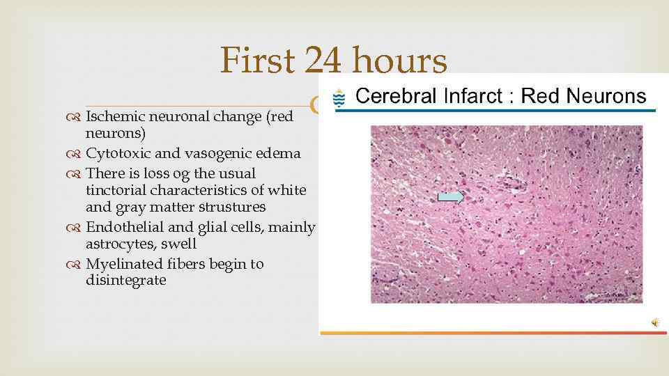 First 24 hours Ischemic neuronal change (red neurons) Cytotoxic and vasogenic edema There is