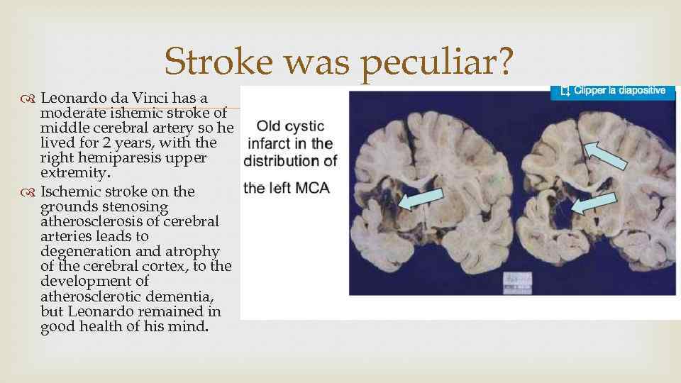 Stroke was peculiar? Leonardo da Vinci has a moderate ishemic stroke of middle cerebral