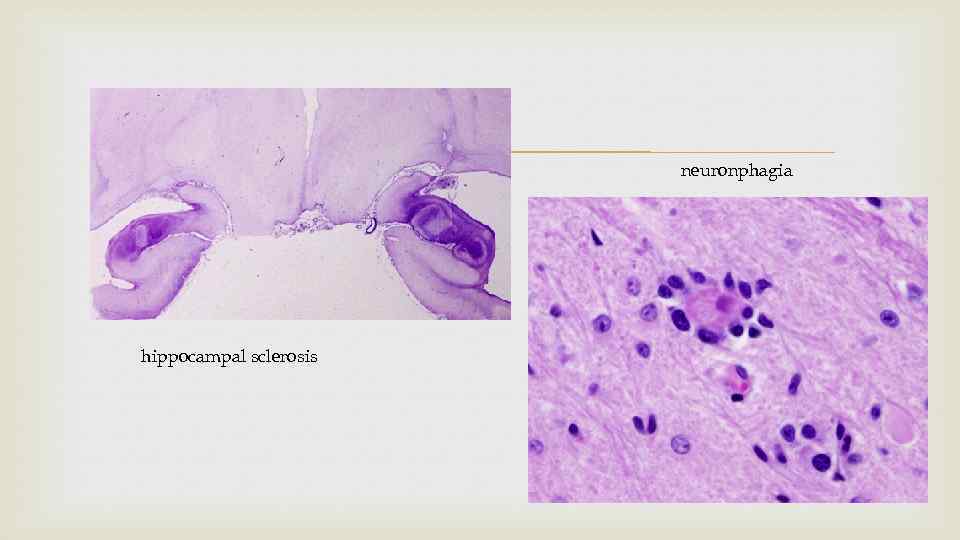  hippocampal sclerosis neuronphagia 