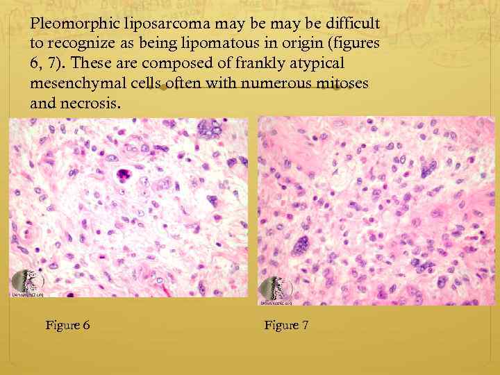 Pleomorphic liposarcoma may be difficult to recognize as being lipomatous in origin (figures 6,