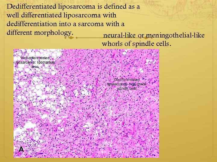 Dedifferentiated liposarcoma is defined as a well differentiated liposarcoma with dedifferentiation into a sarcoma