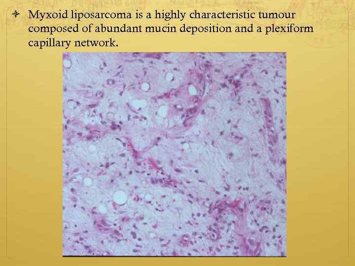  Myxoid liposarcoma is a highly characteristic tumour composed of abundant mucin deposition and
