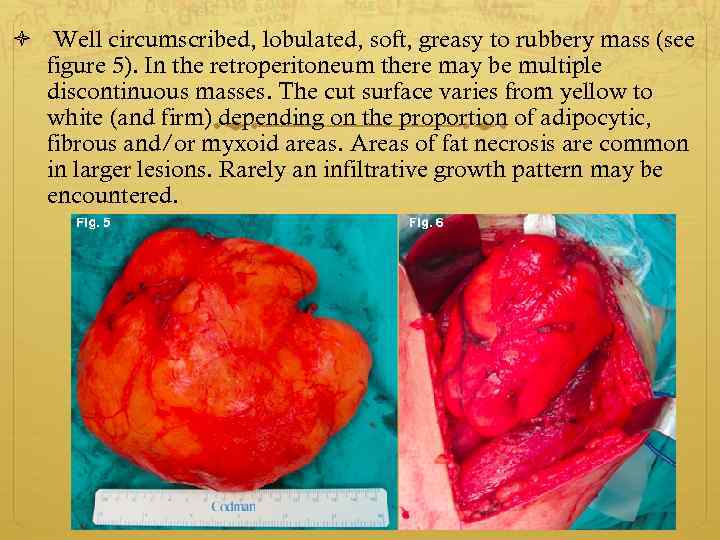  Well circumscribed, lobulated, soft, greasy to rubbery mass (see figure 5). In the