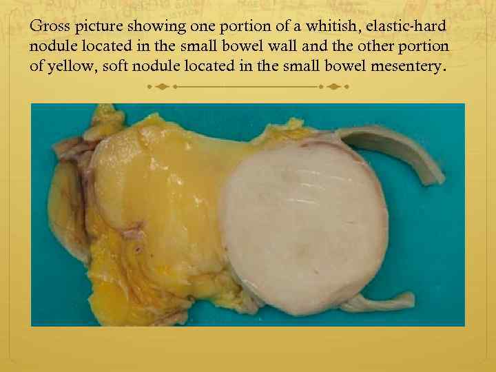 Gross picture showing one portion of a whitish, elastic-hard nodule located in the small