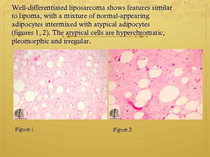 Well-differentiated liposarcoma shows features similar to lipoma, with a mixture of normal-appearing adipocytes intermixed