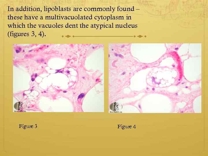 In addition, lipoblasts are commonly found – these have a multivacuolated cytoplasm in which