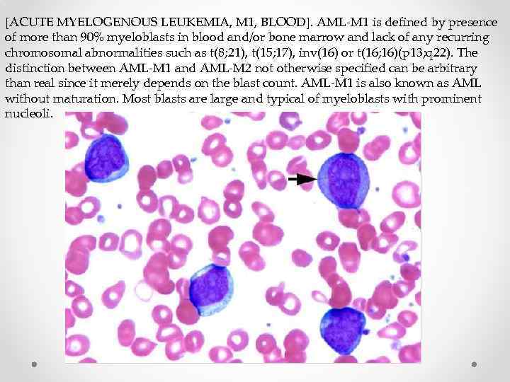 [ACUTE MYELOGENOUS LEUKEMIA, M 1, BLOOD]. AML-M 1 is defined by presence of more