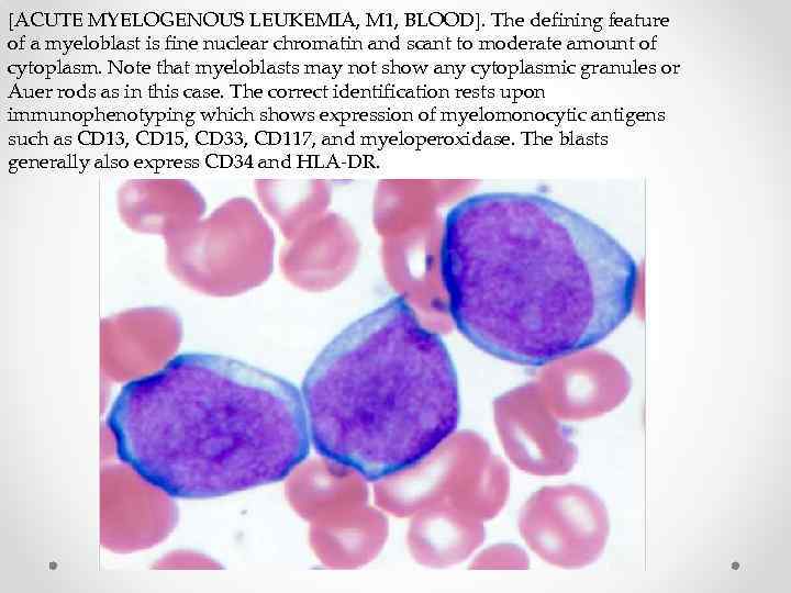 [ACUTE MYELOGENOUS LEUKEMIA, M 1, BLOOD]. The defining feature of a myeloblast is fine