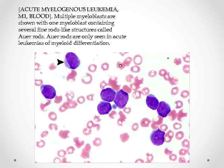 [ACUTE MYELOGENOUS LEUKEMIA, M 1, BLOOD]. Multiple myeloblasts are shown with one myeloblast containing
