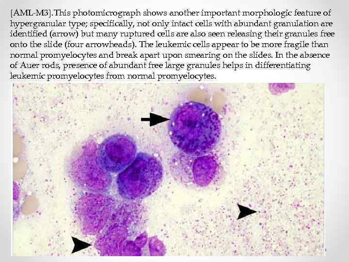 [AML-M 3]. This photomicrograph shows another important morphologic feature of hypergranular type; specifically, not