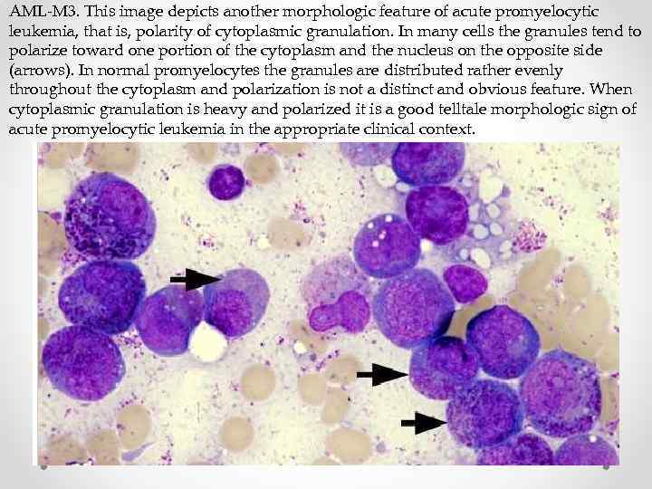 AML-M 3. This image depicts another morphologic feature of acute promyelocytic leukemia, that is,