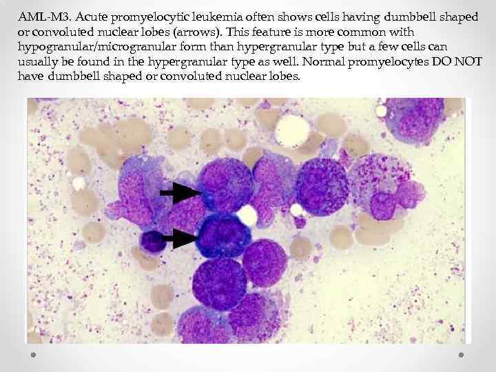 AML-M 3. Acute promyelocytic leukemia often shows cells having dumbbell shaped or convoluted nuclear