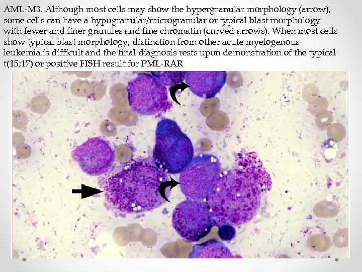 AML-M 3. Although most cells may show the hypergranular morphology (arrow), some cells can