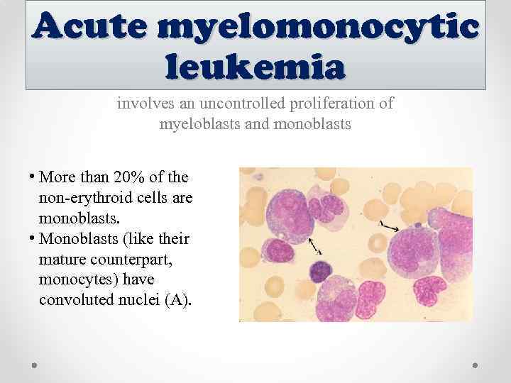 Acute myelomonocytic leukemia involves an uncontrolled proliferation of myeloblasts and monoblasts • More than