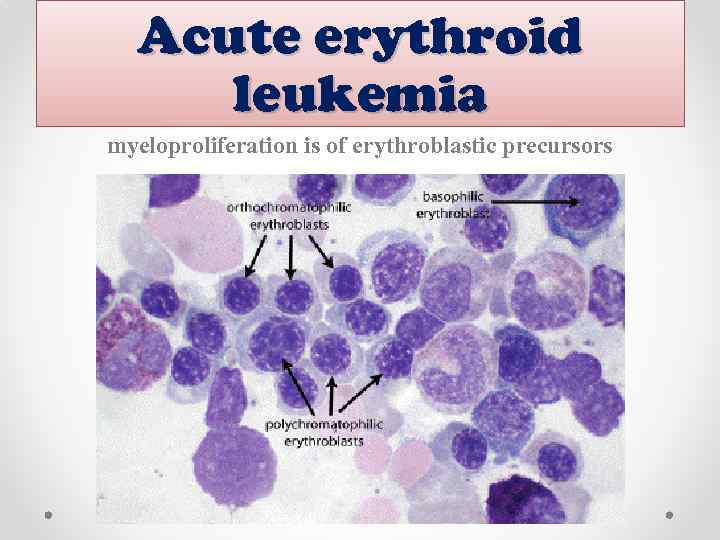Acute erythroid leukemia myeloproliferation is of erythroblastic precursors 