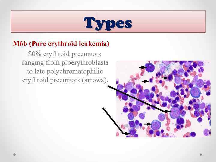 Types M 6 b (Pure erythroid leukemia) 80% erythroid precursors ranging from proerythroblasts to