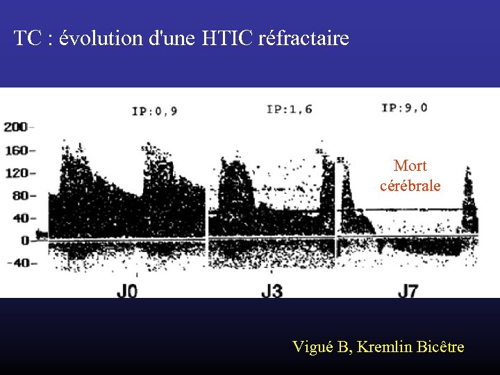 TC : évolution d'une HTIC réfractaire Mort cérébrale Vigué B, Kremlin Bicêtre 