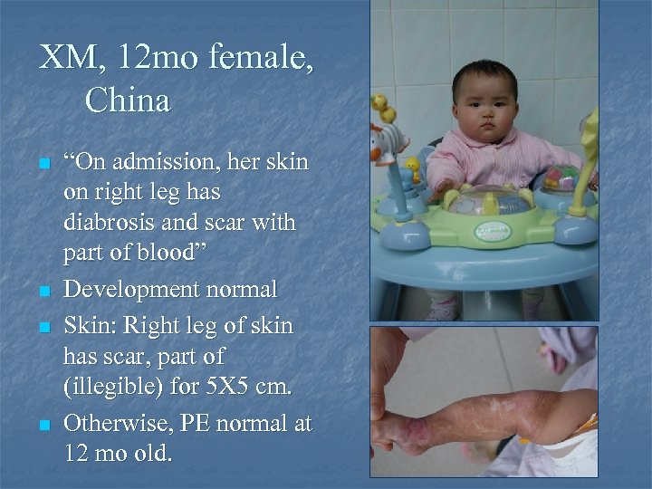 XM, 12 mo female, China n n “On admission, her skin on right leg