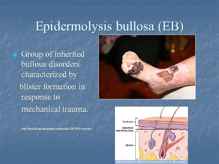 Epidermolysis bullosa (EB) Group of inherited bullous disorders characterized by blister formation in response