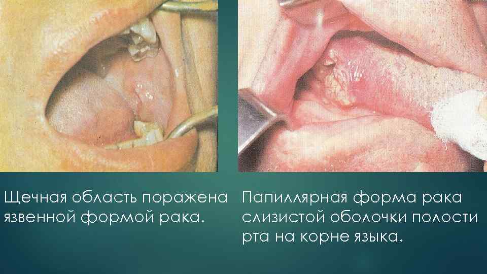 Щечная область поражена Папиллярная форма рака язвенной формой рака. слизистой оболочки полости рта на