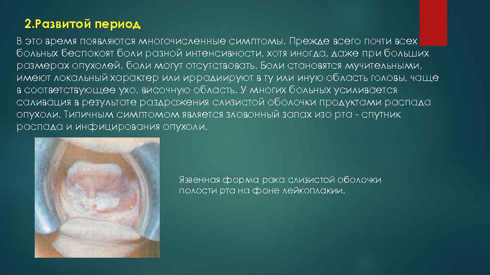 2. Развитой период В это время появляются многочисленные симптомы. Прежде всего почти всех больных