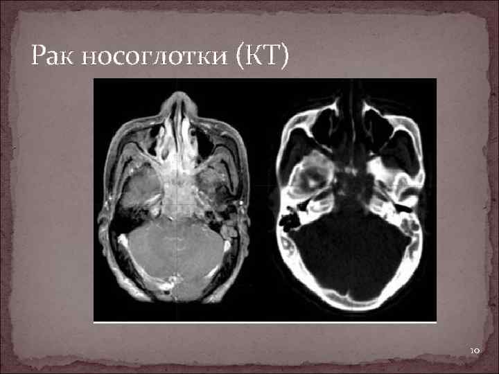 Рак носоглотки (КТ) 10 