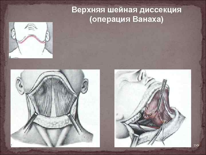 Верхняя шейная диссекция (операция Ванаха) 110 