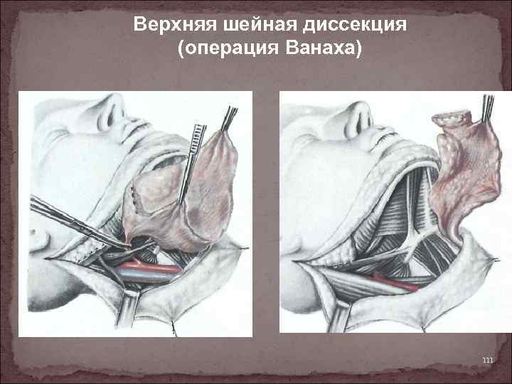 Верхняя шейная диссекция (операция Ванаха) 111 
